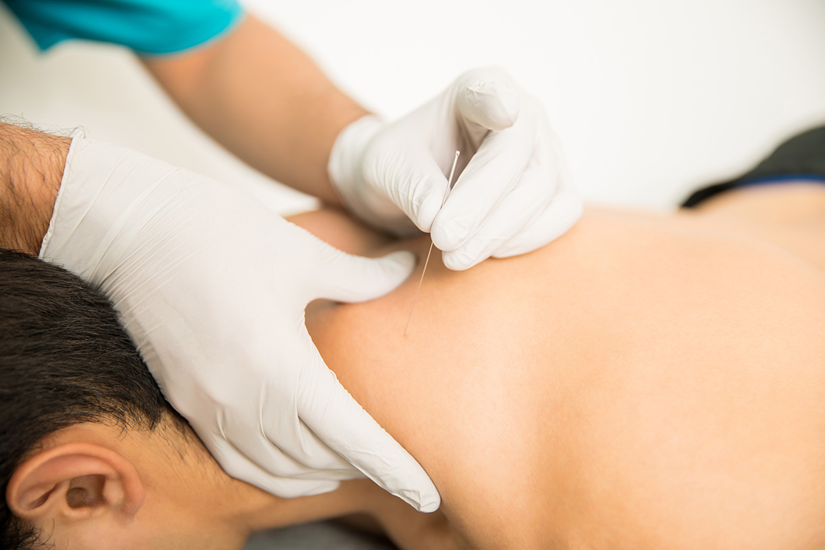 dry needling therapist inserting needle in person's upper shoulder area